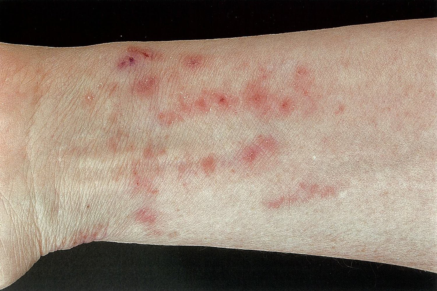 Atopic dermatitis