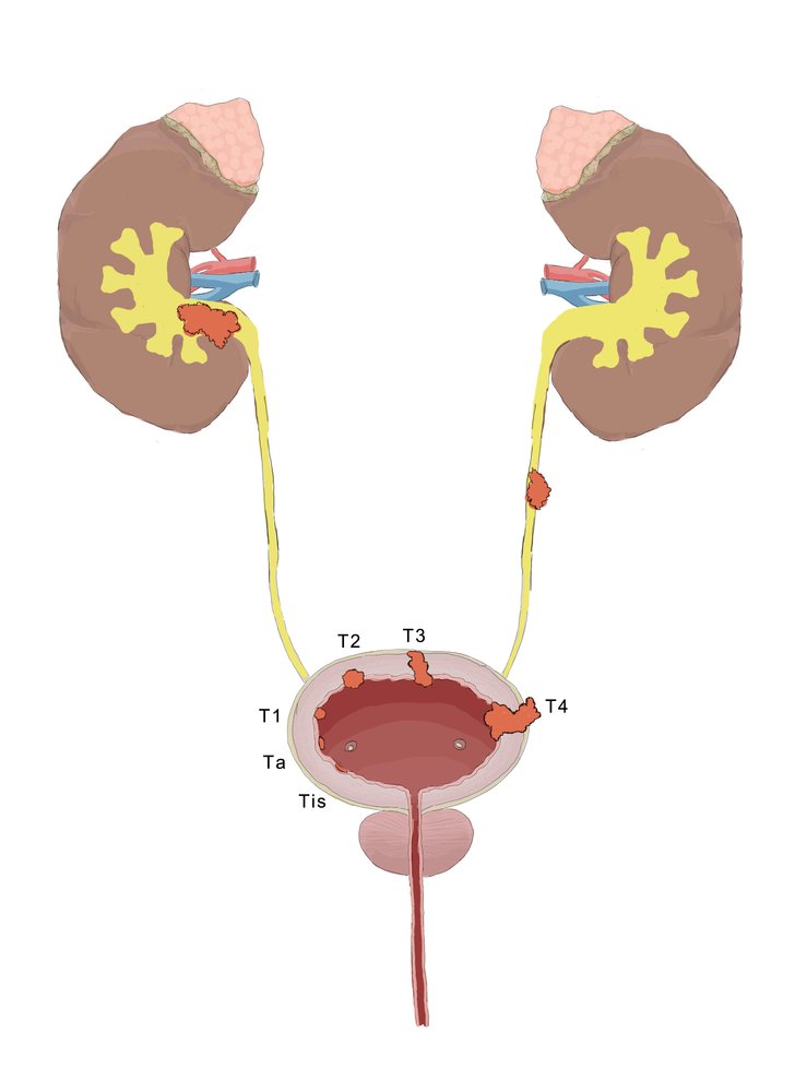 Urinary tract tumors