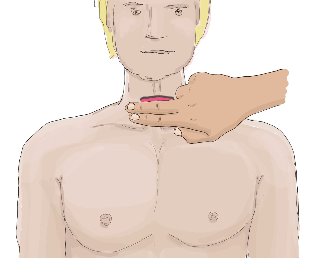 Kocher's incision