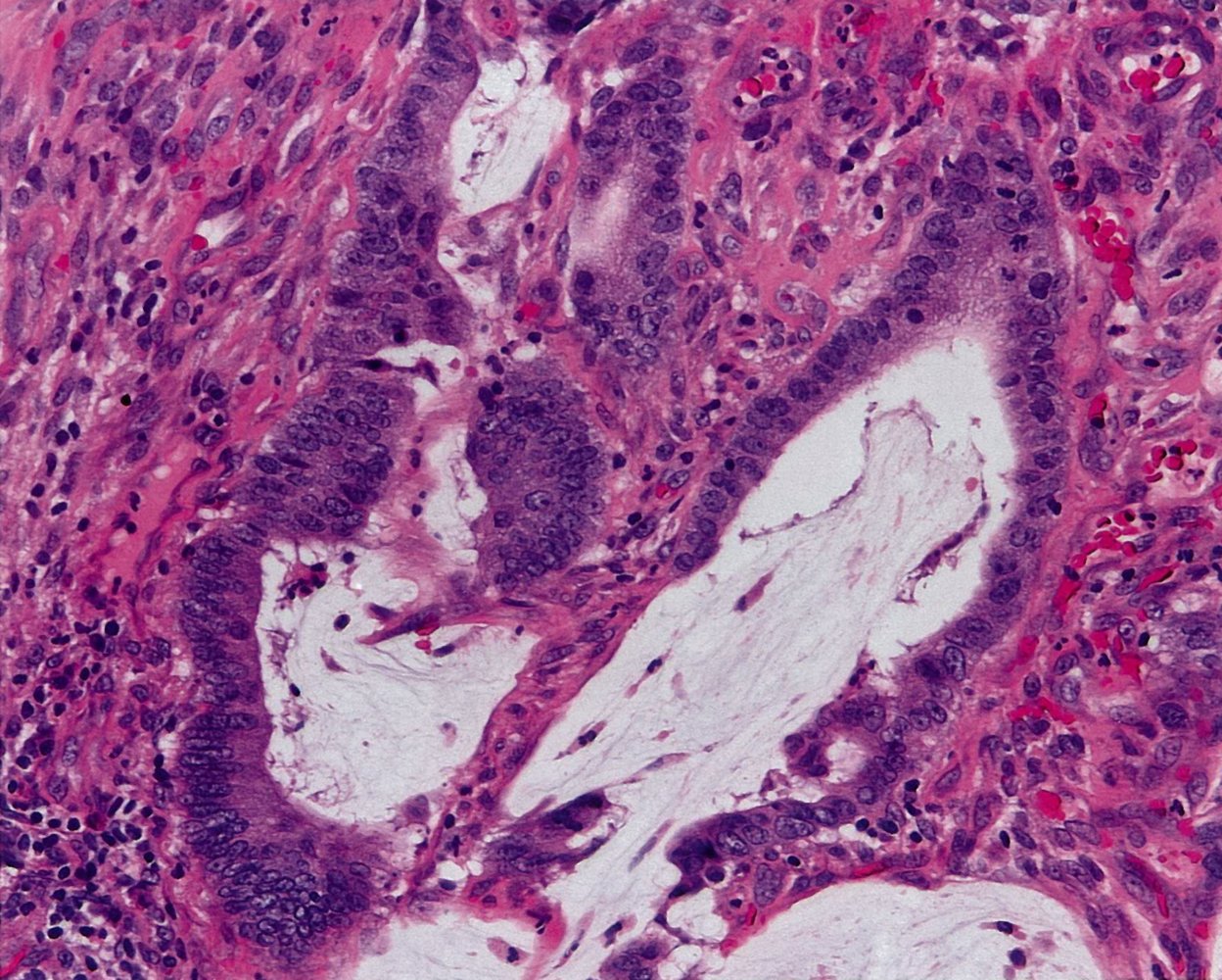 Mucinous adenocarcinoma of the colon