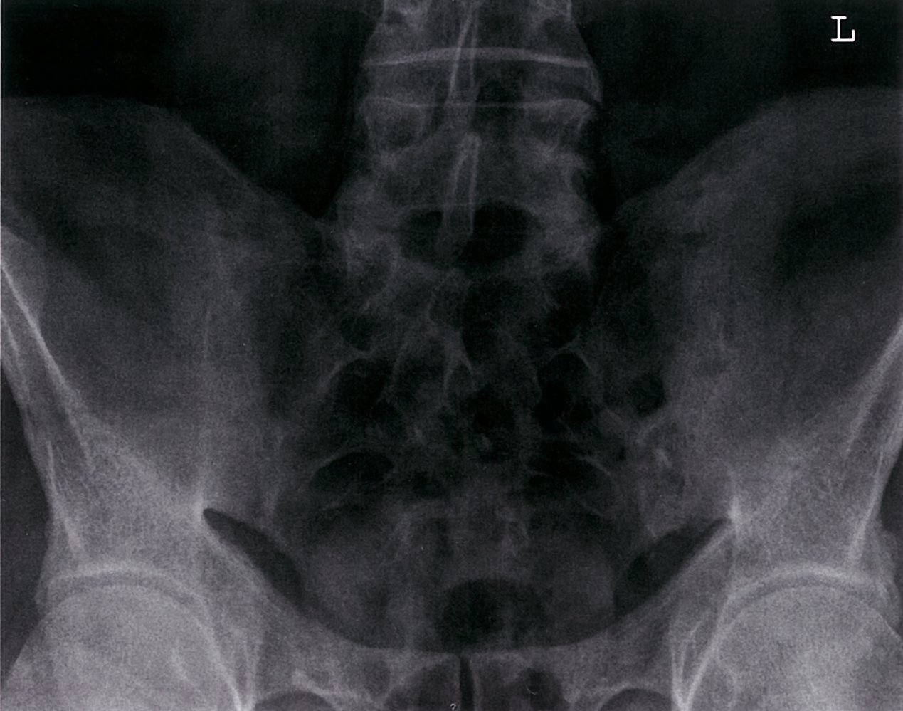 Psoriatic arthritis