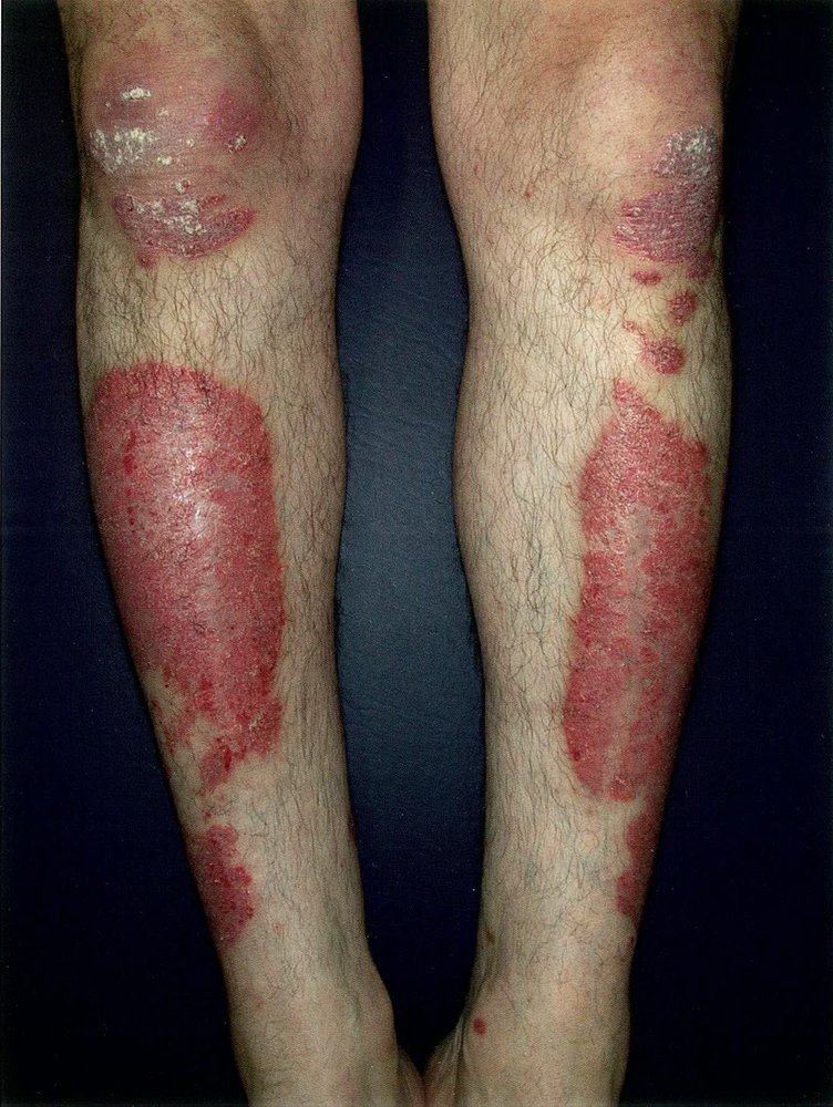 Psoriasis