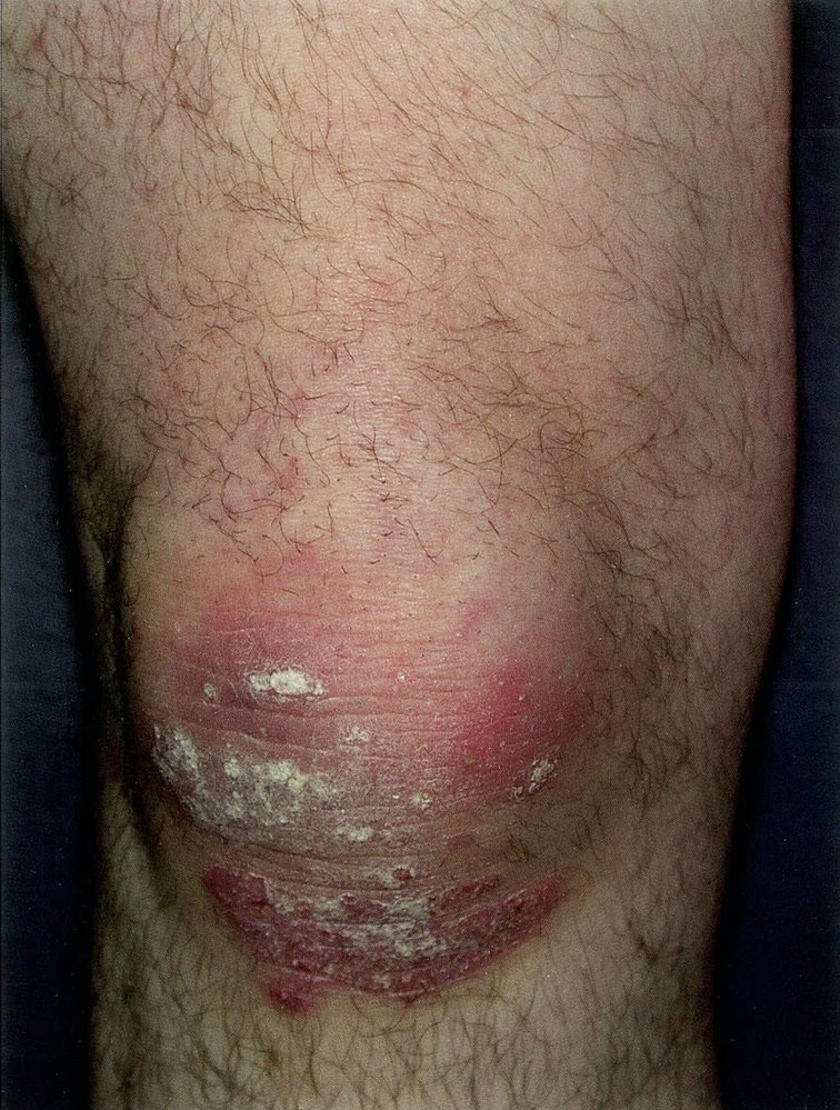 Psoriasis of the knee