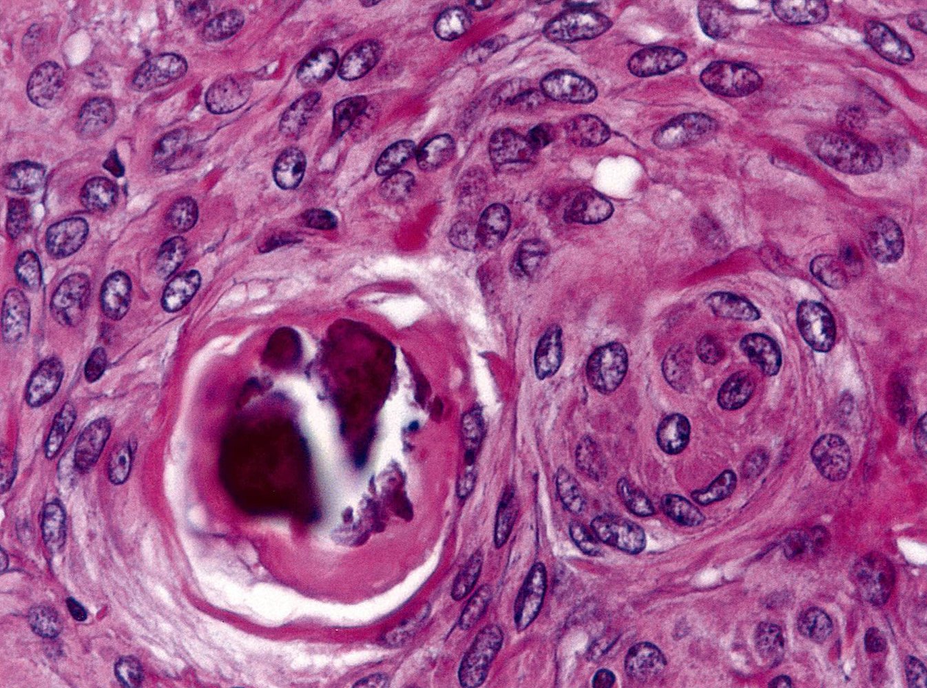 Psammoma body and meningocytic whorl