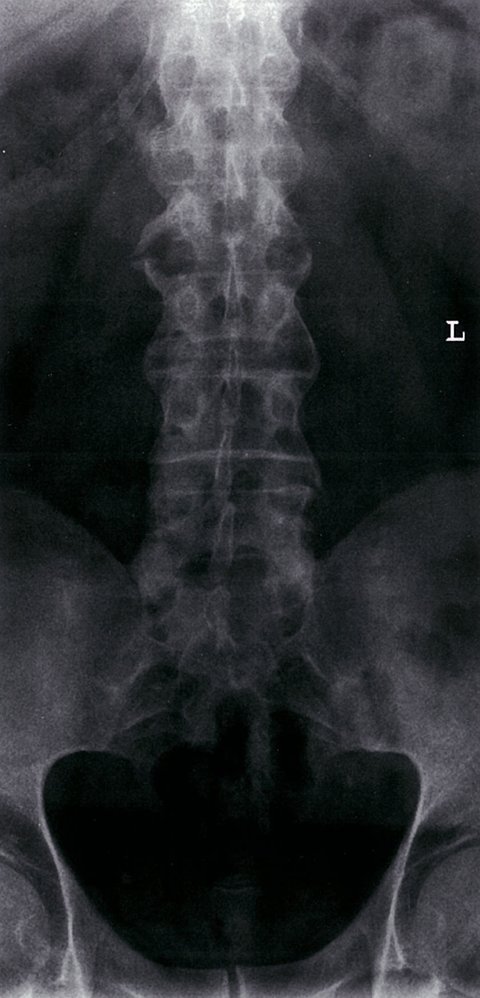 Psoriatic arthritis