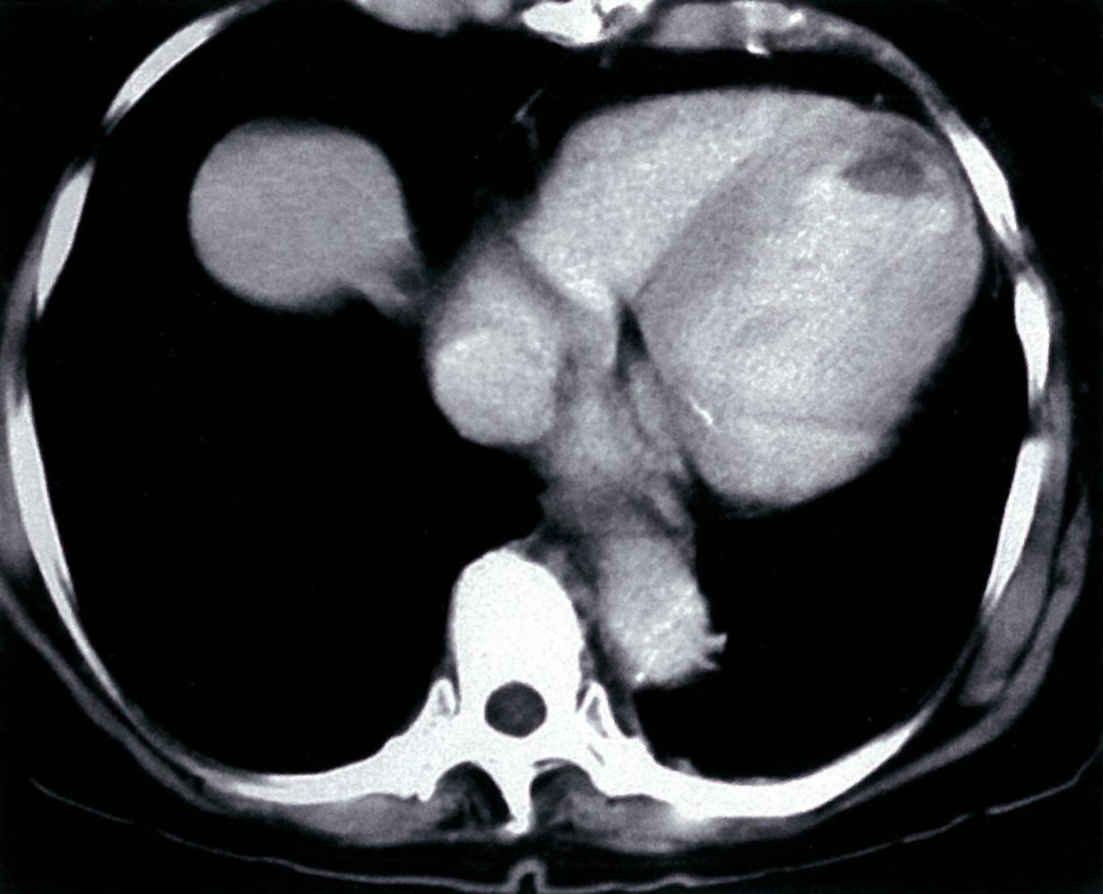 Left ventricular mural thrombus