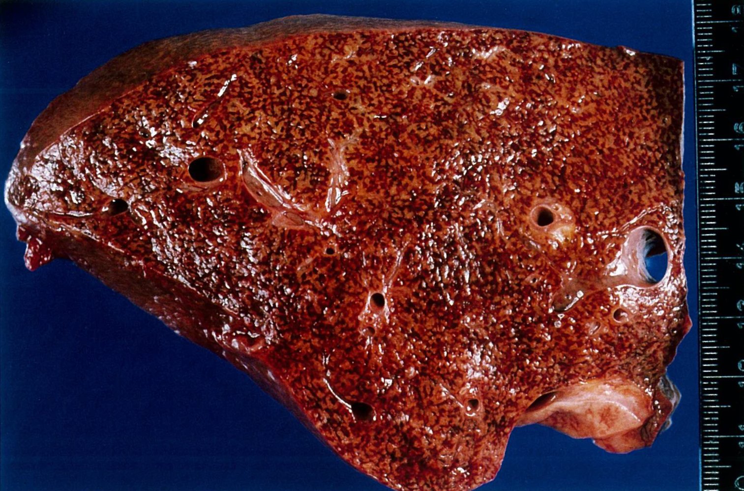 Hepatic congestion (nutmeg liver)
