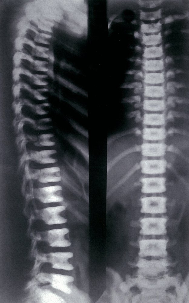 Osteopetrosis