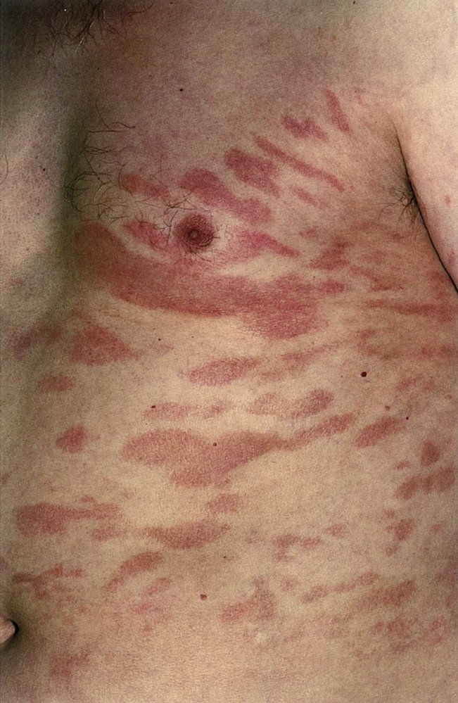 Cutaneous T-cell lymphoma