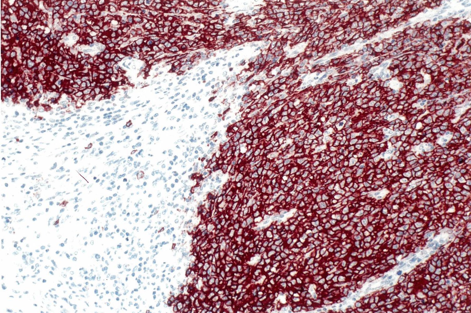 B-cell Non-Hodgkin lymphoma