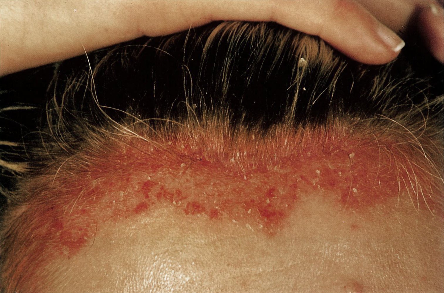Psoriasis capitis