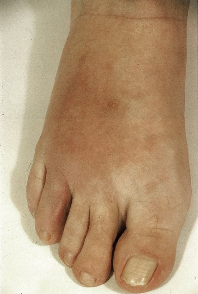 Psoriatic arthritis