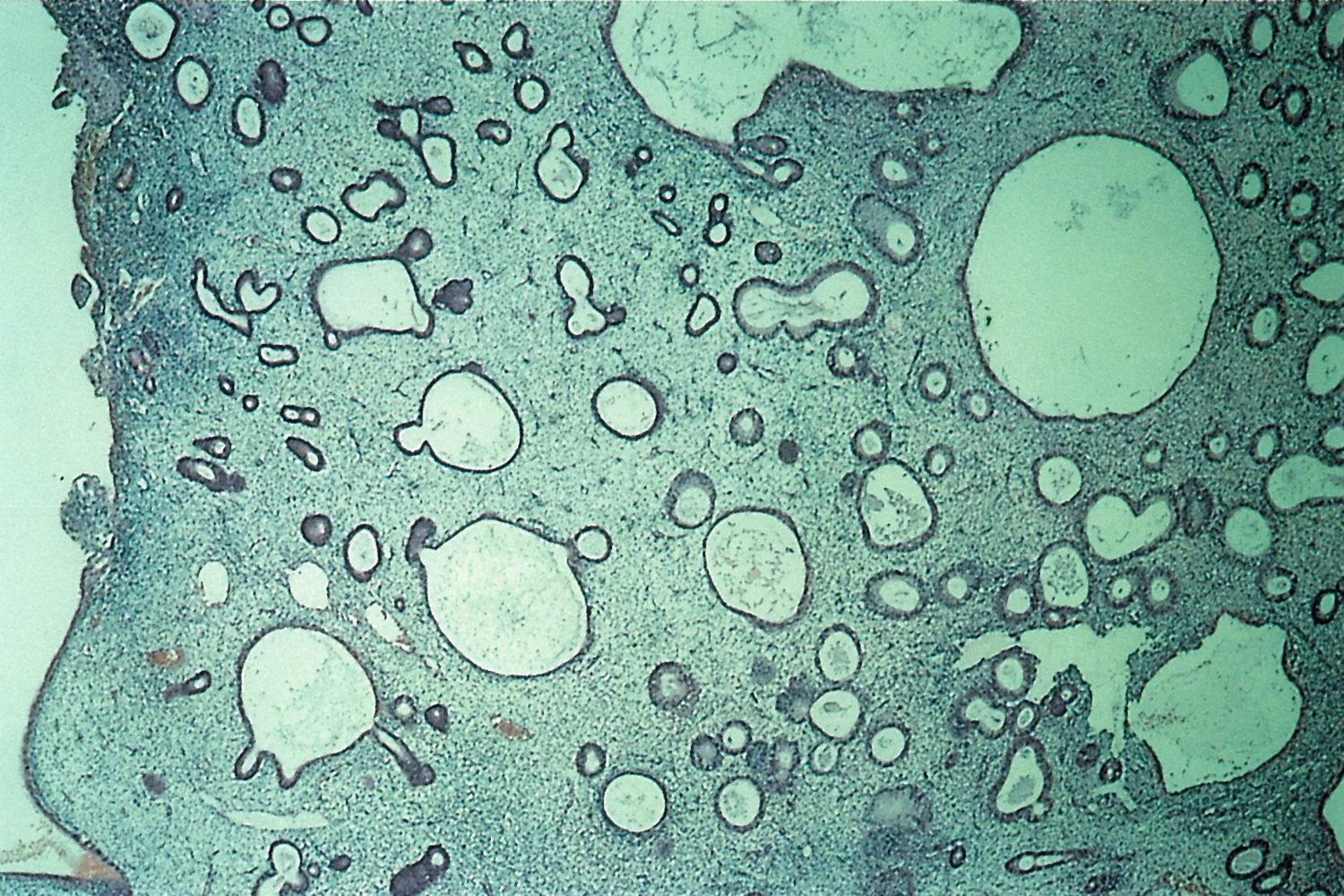 Simple endometrial hyperplasia