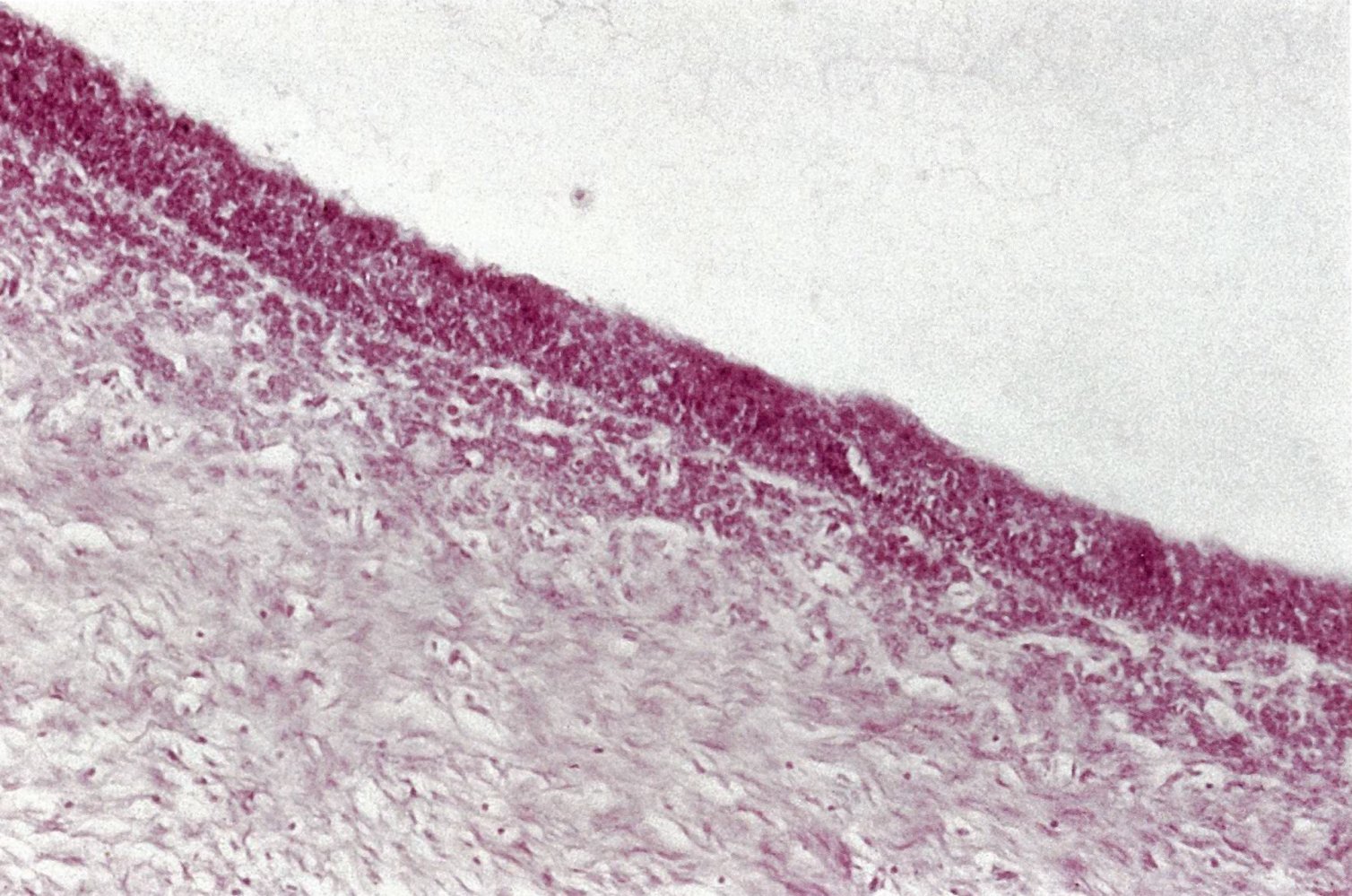 Polycystic ovary syndrome (PCOS; Stein-Leventhal syndrome)