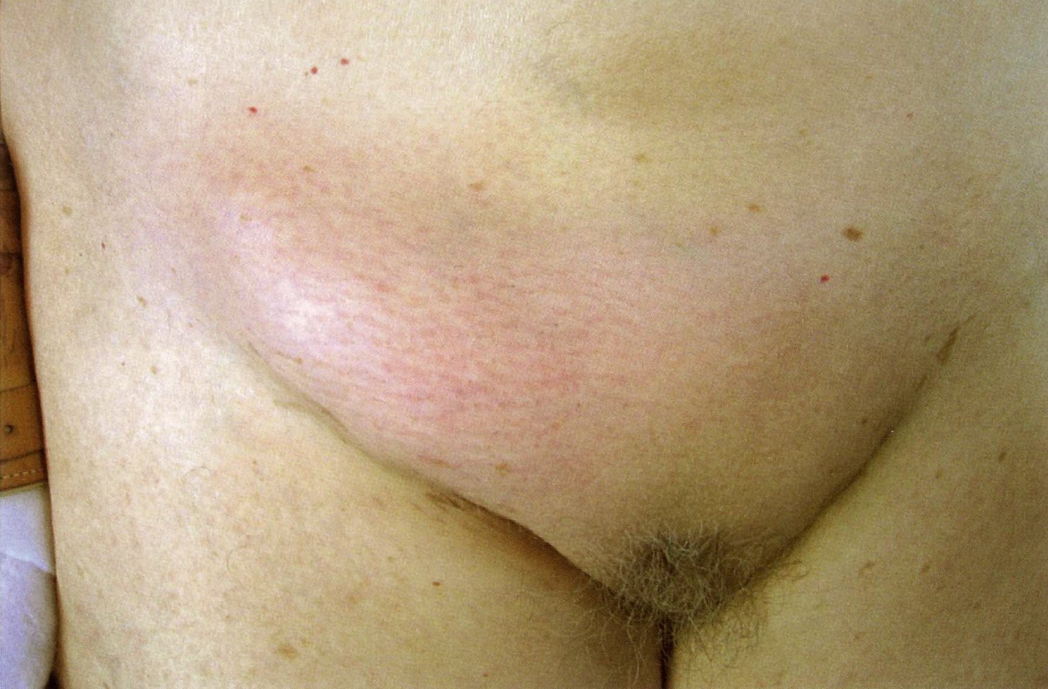 Strangulated inguinal hernia