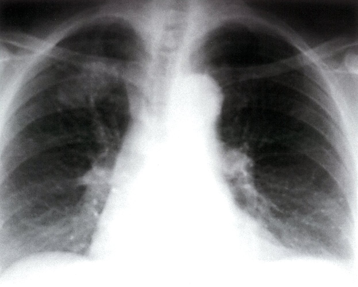 Right upper lobe lung mass