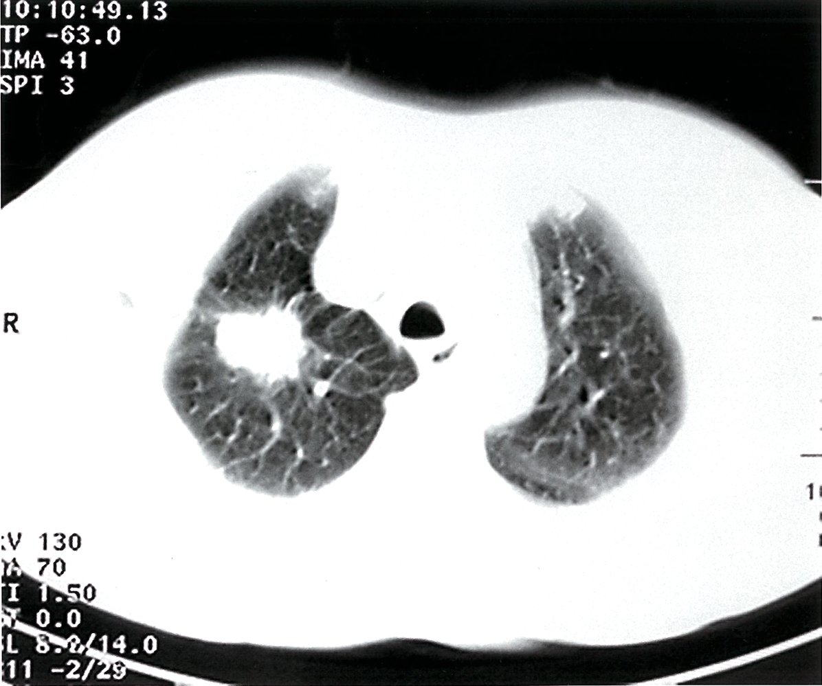 Lung mass