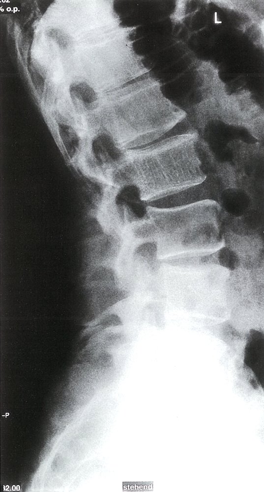 Intraosseous hemangioma in the lumbar vertebrae