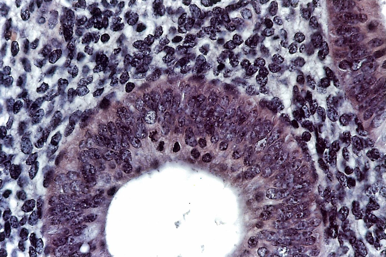 Glandular-cystic, simple endometrial hyperplasia (magnified)