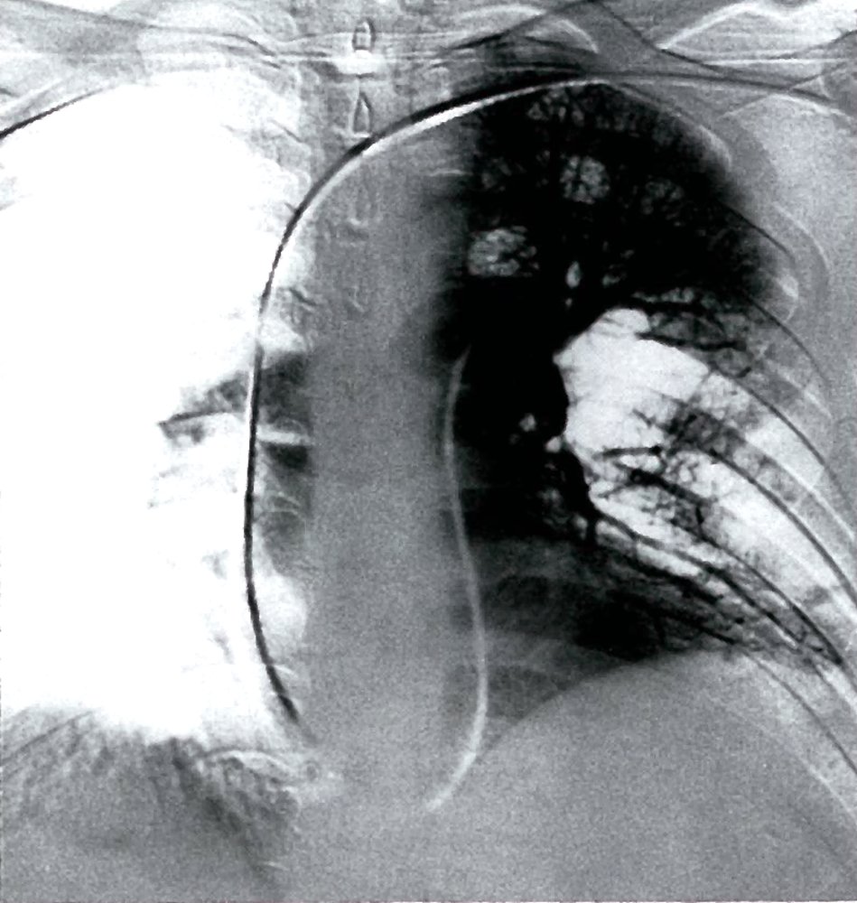 Pulmonary angiography