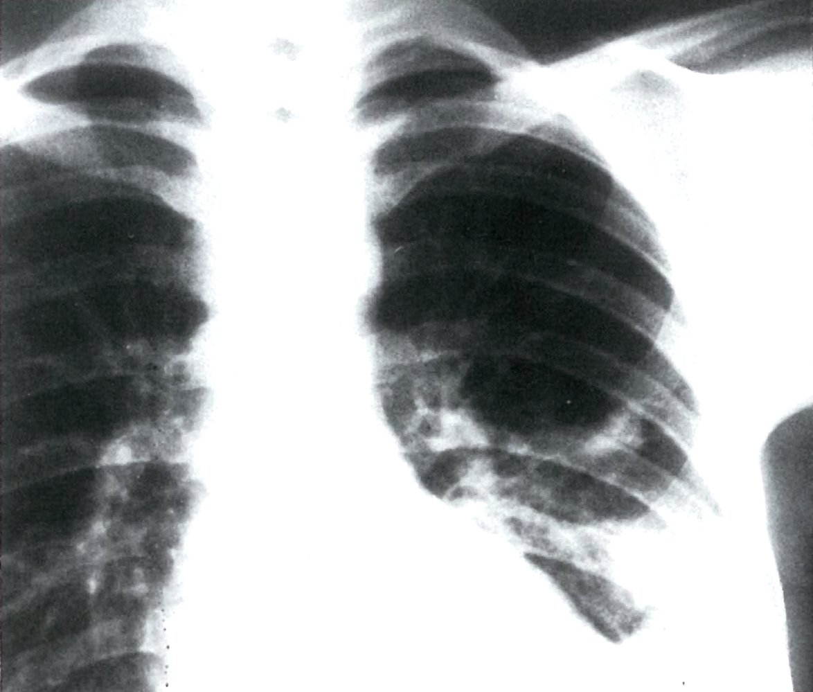 Pulmonary embolism with infarction from pneumonia (left side)