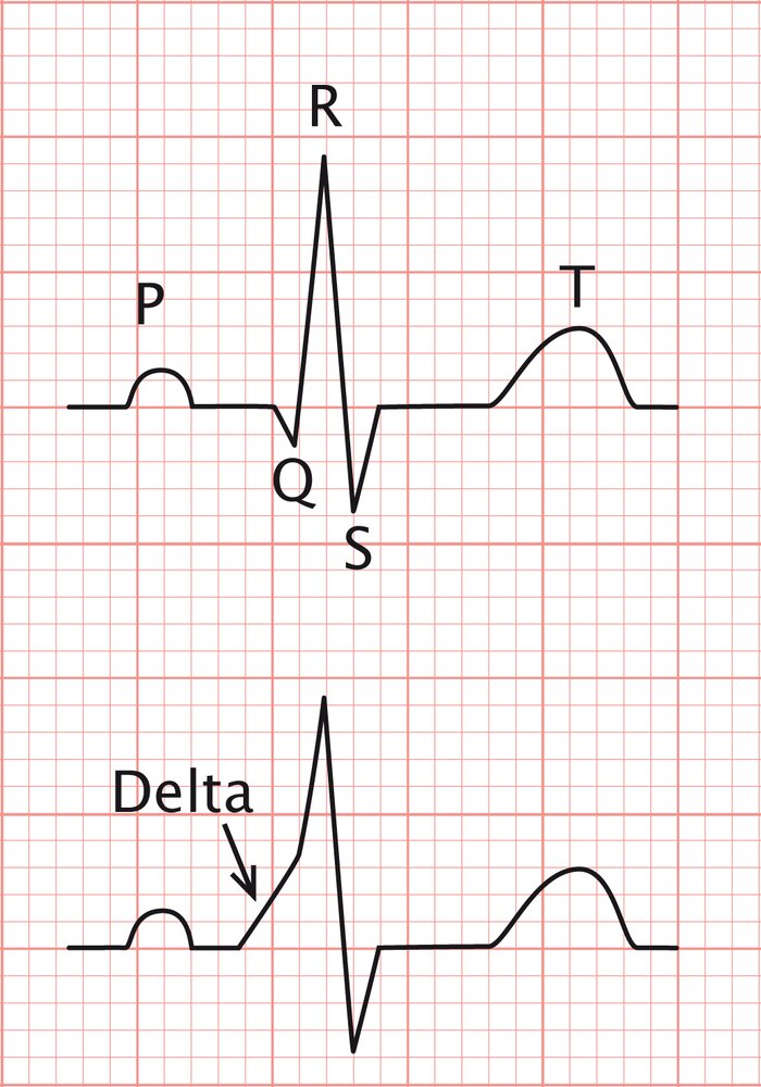 Delta wave