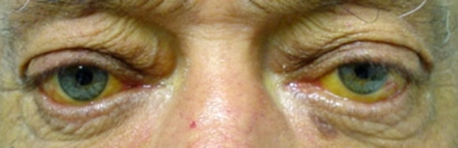 Jaundice (icterus)