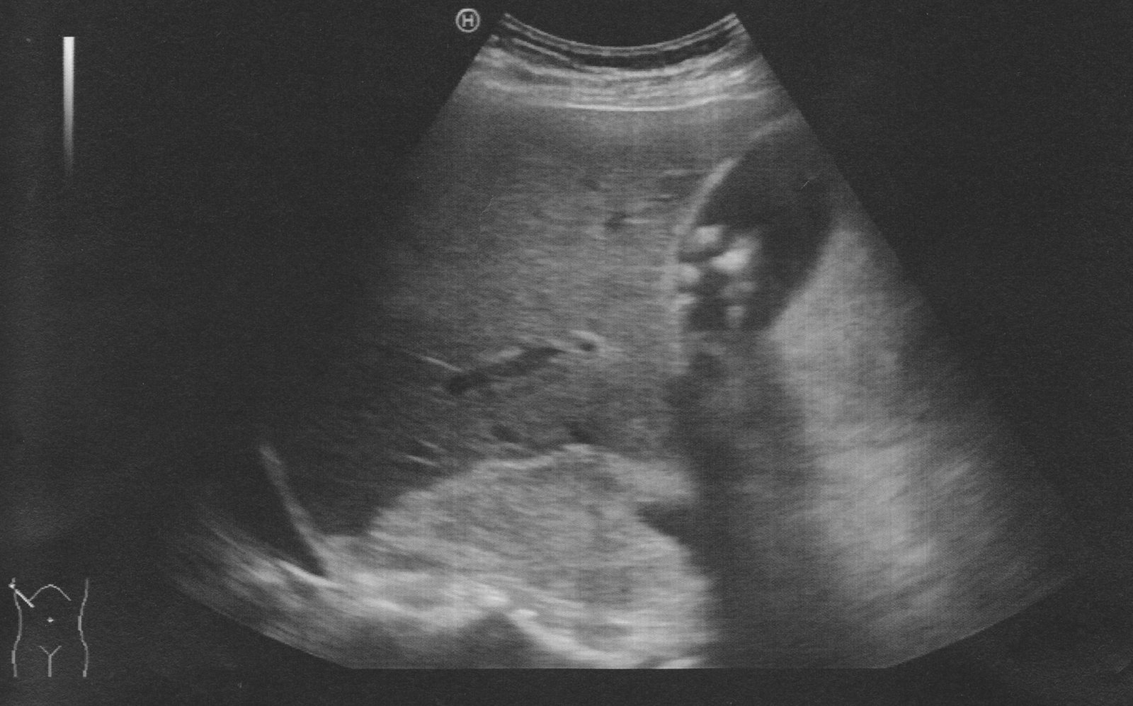 Cholelithiasis