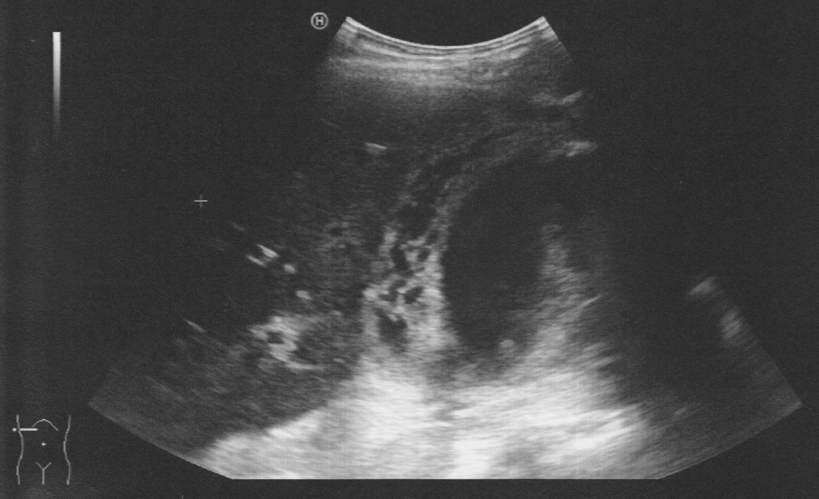 Acute cholecystitis