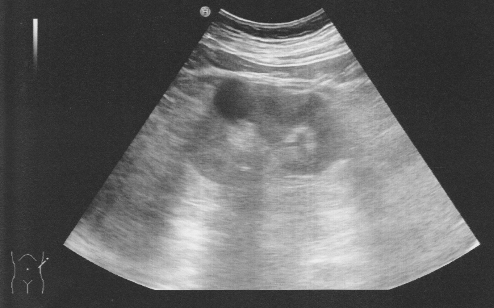 Renal cyst