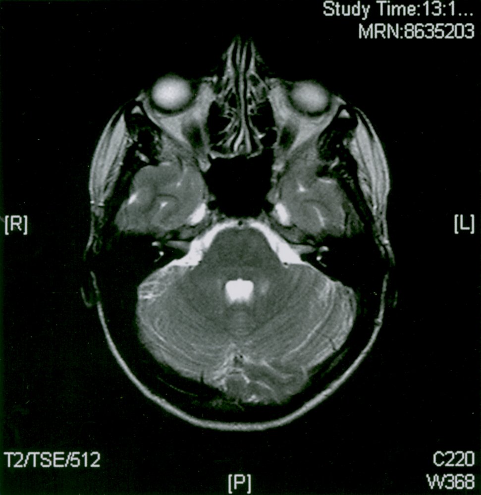 Multiple sclerosis