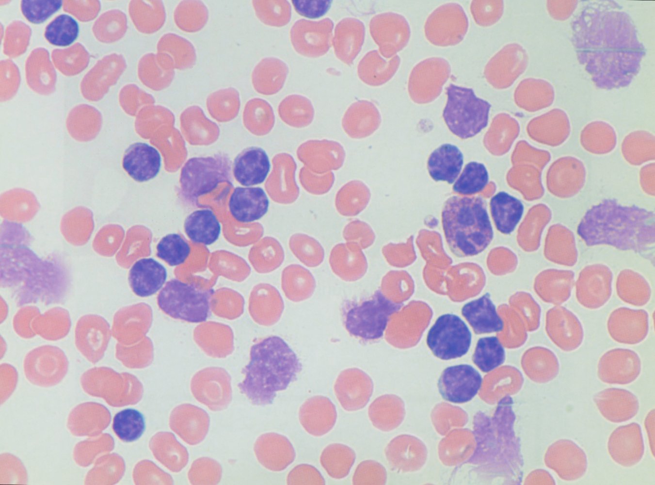 Smudge cells in chronic lymphocytic leukemia