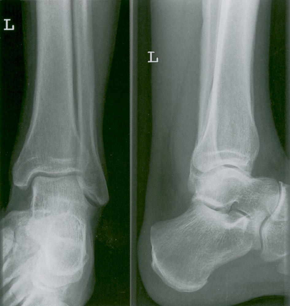 Hypertrophic osteoarthropathy