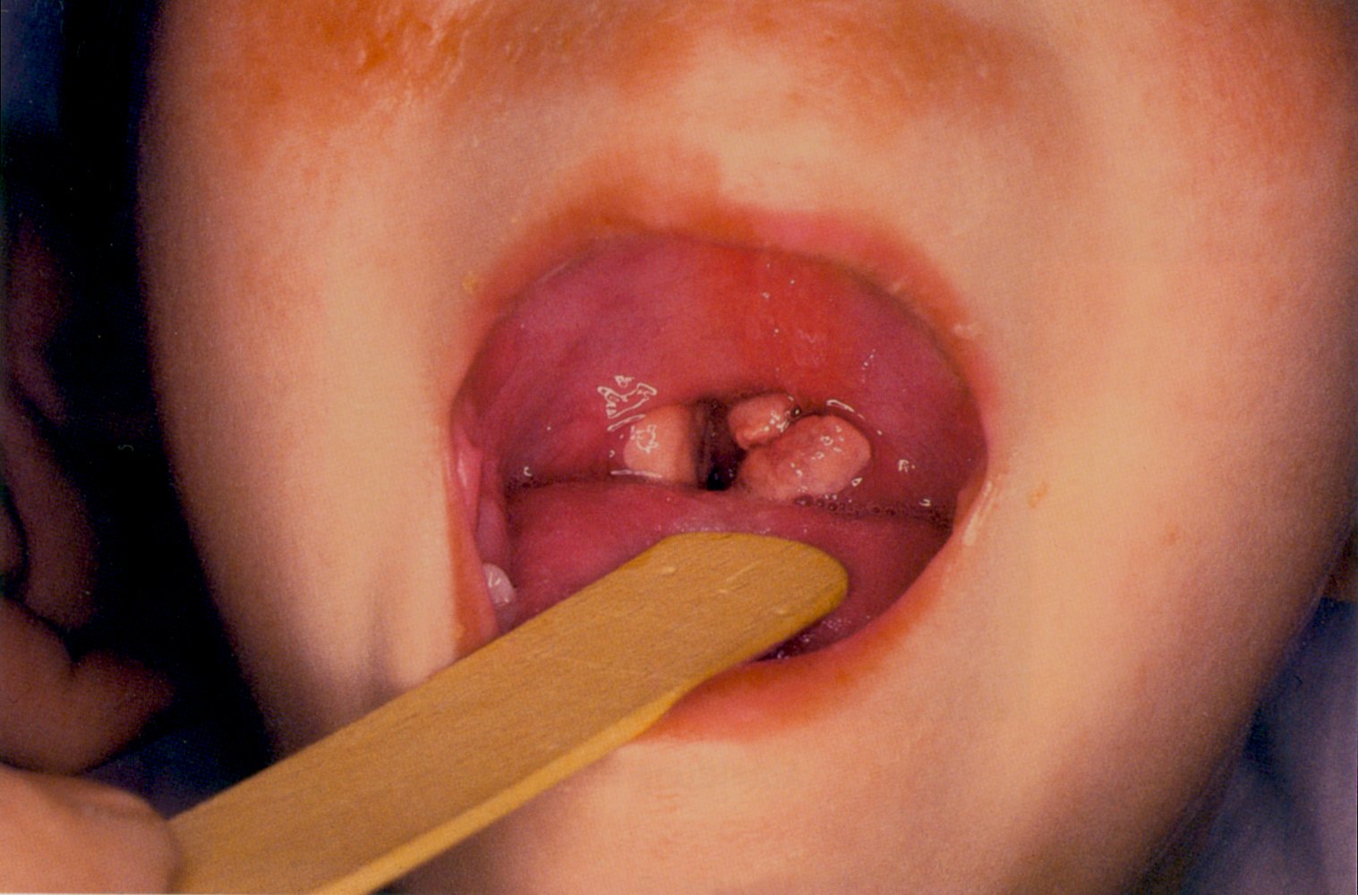 Infectious mononucleosis