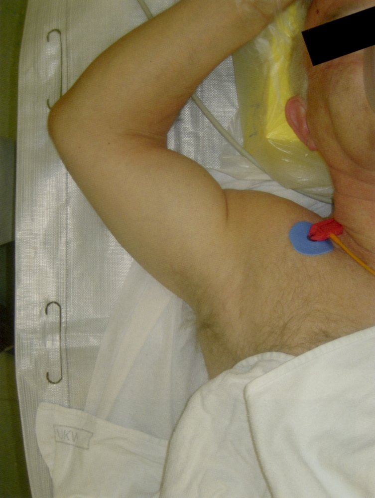 Inferior dislocation of the right shoulder