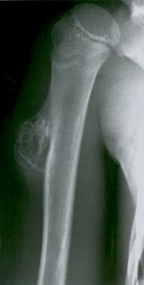 Osteochondroma of the humerus