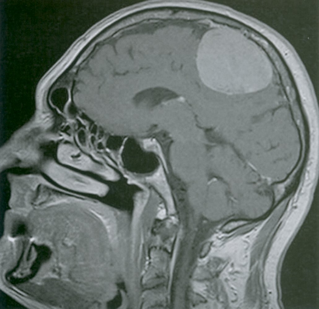 Parasagittal meningioma