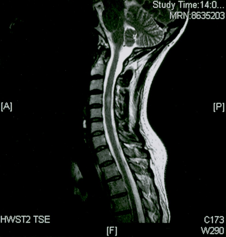 Multiple sclerosis