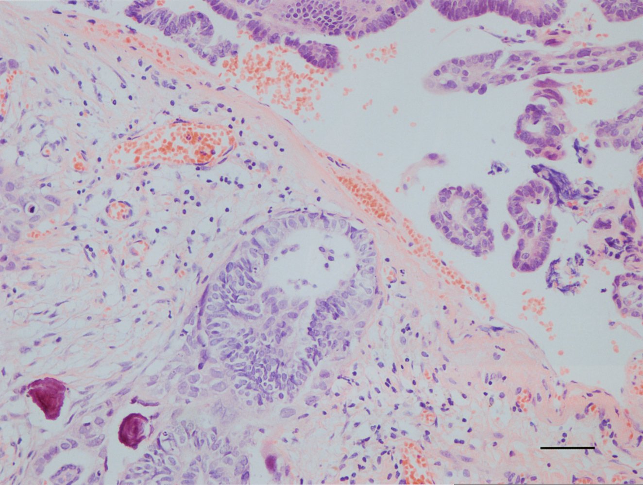 Serous papillary cystadenoma of the ovary with Psammoma bodies