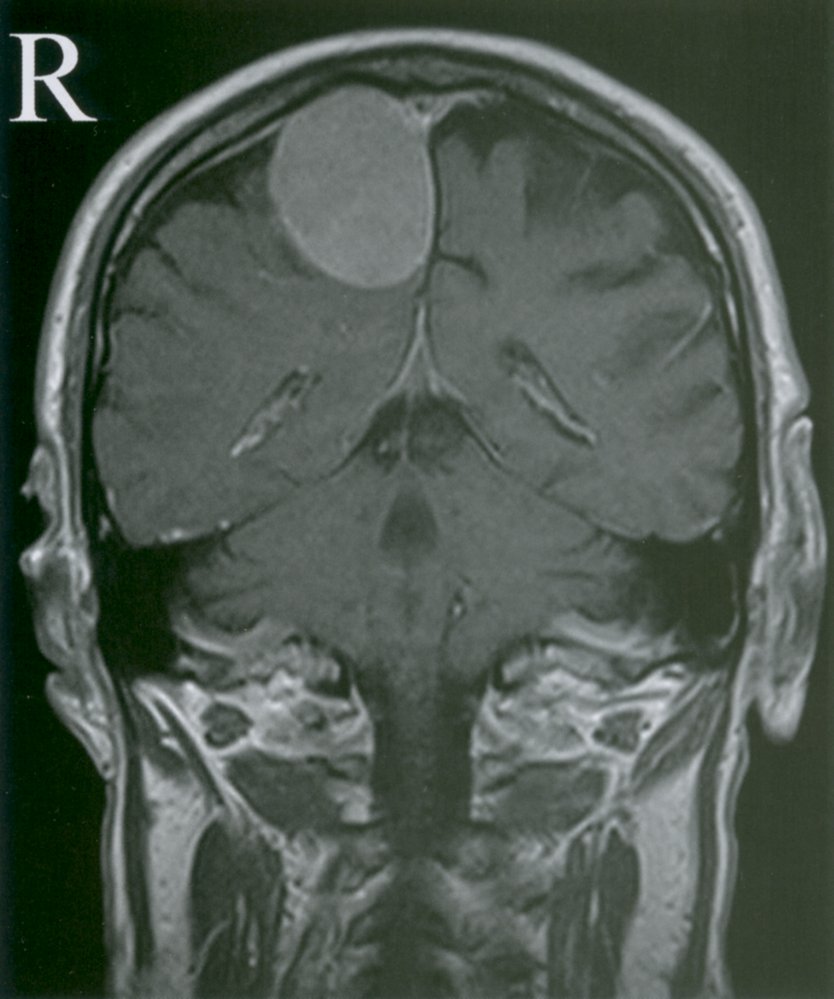 Parasagittal meningioma