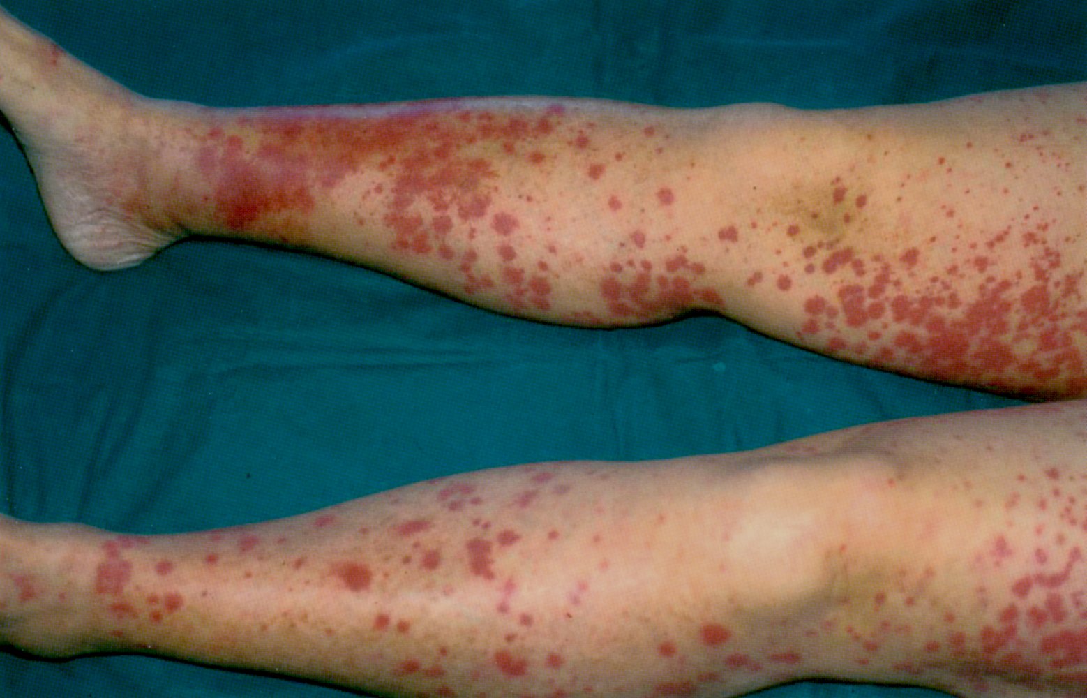 Cryoglobulinemic vasculitis