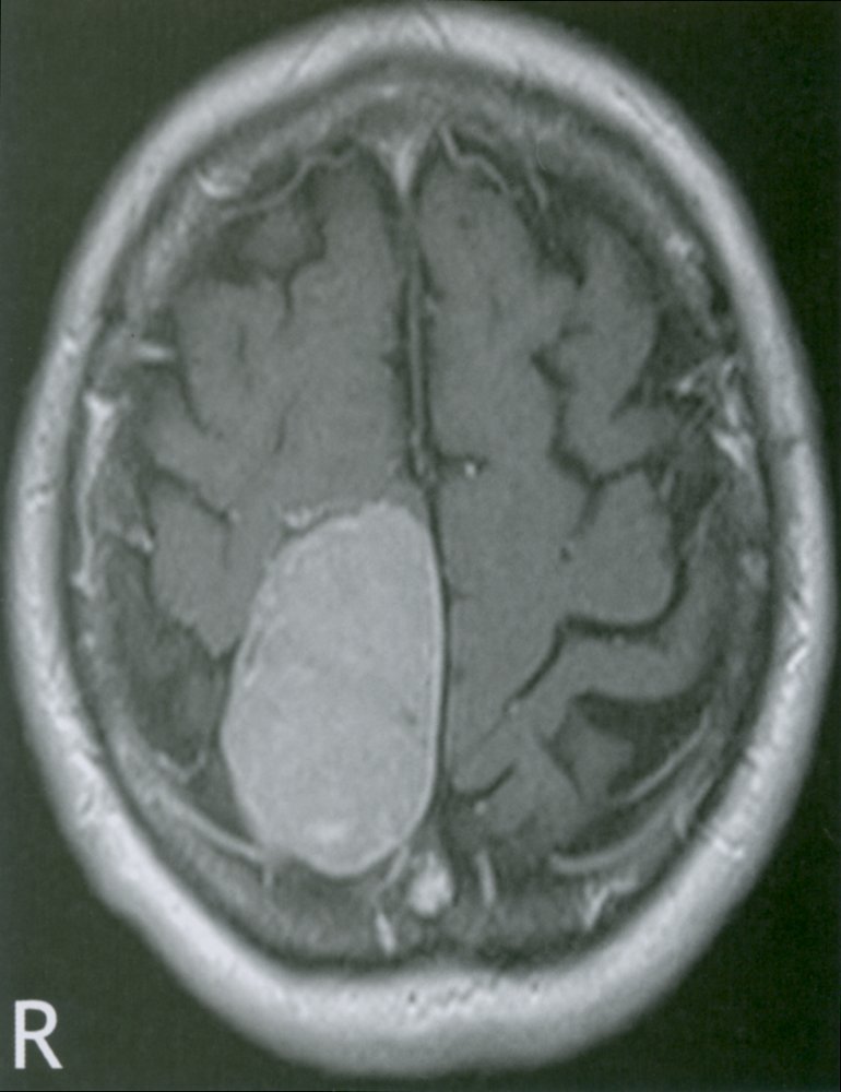 Parasagittal meningioma