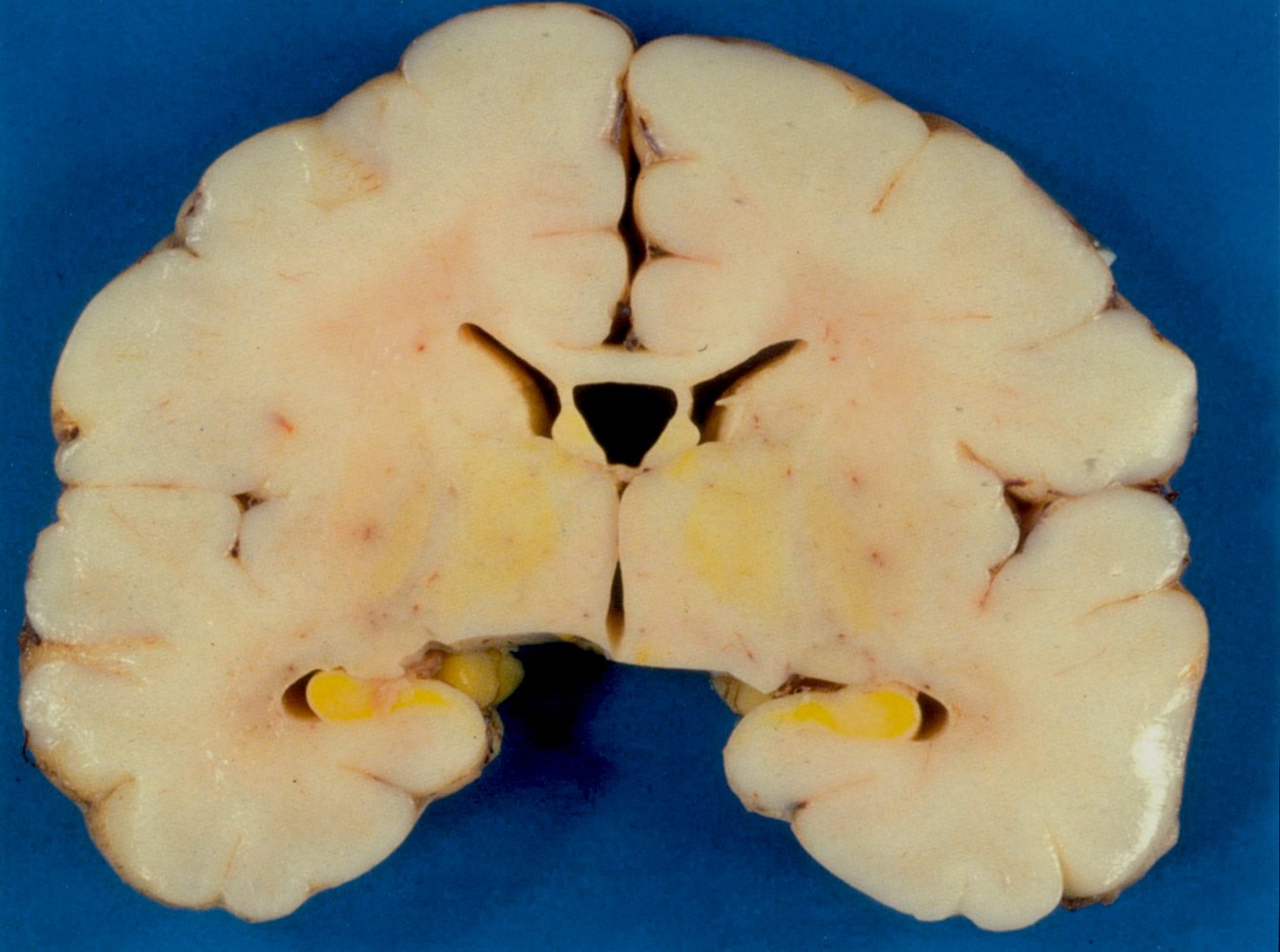 Kernicterus