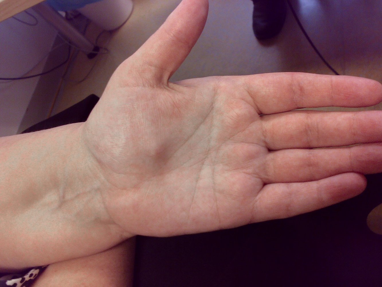 Rheumatoid cutaneous nodules