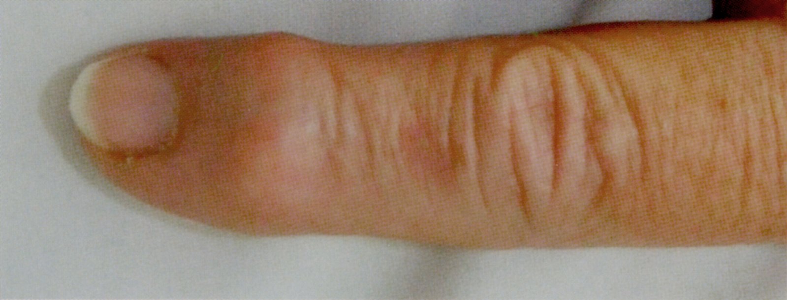 Heberden node