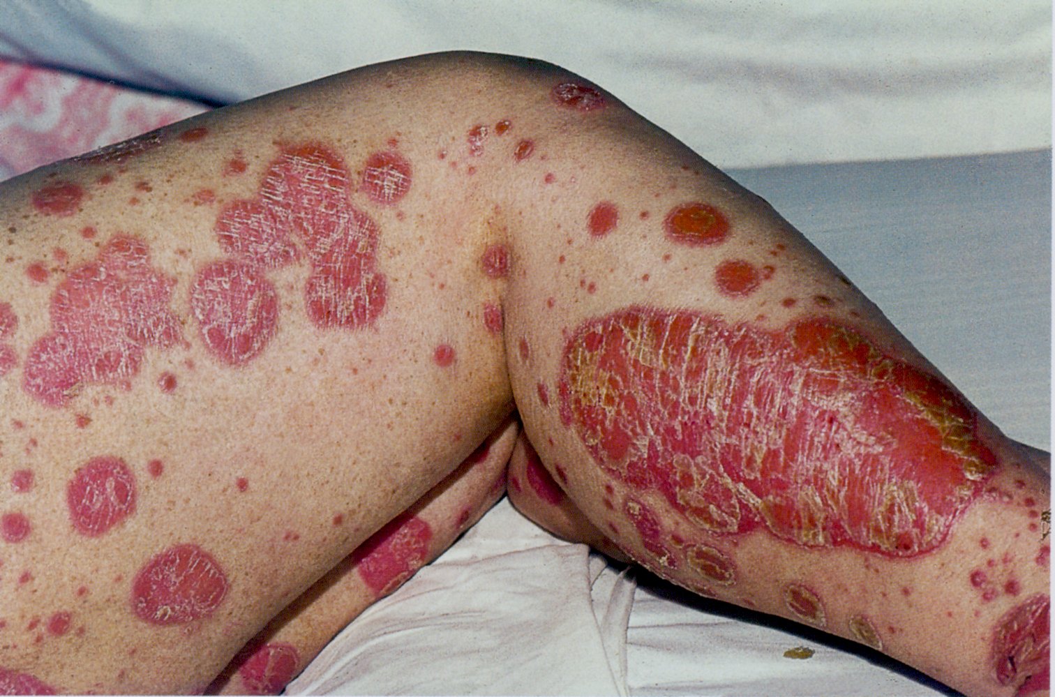 Disseminated plaque psoriasis