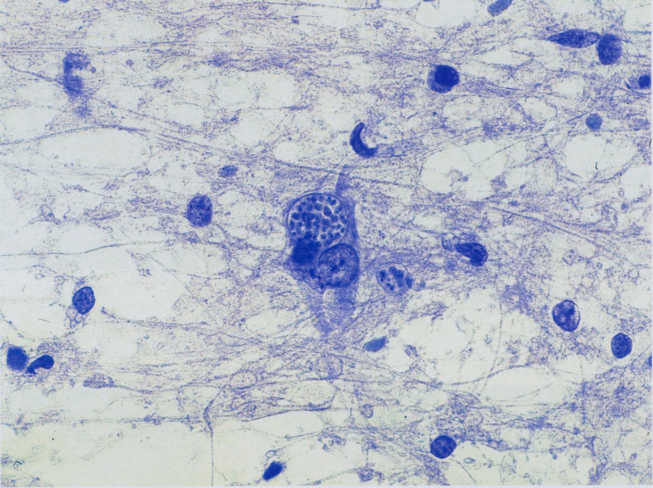 Toxoplasma gondii in brain biopsy