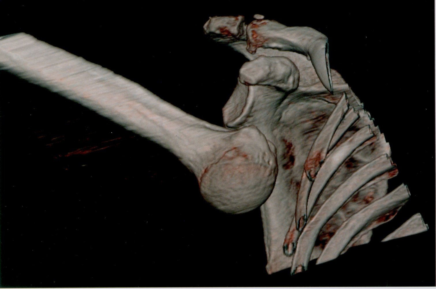 Inferior shoulder dislocation (luxatio erecta) after a fall from a ladder