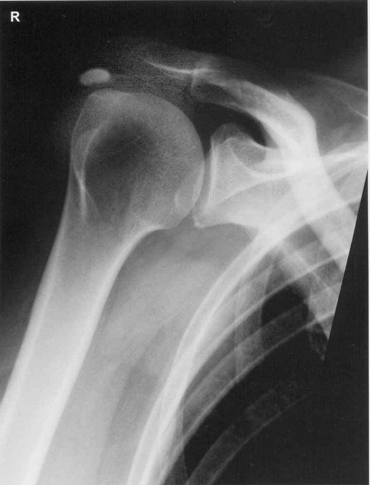 Basic calcium phosphate-associated calcific periarthritis (calcific tendinitis)
