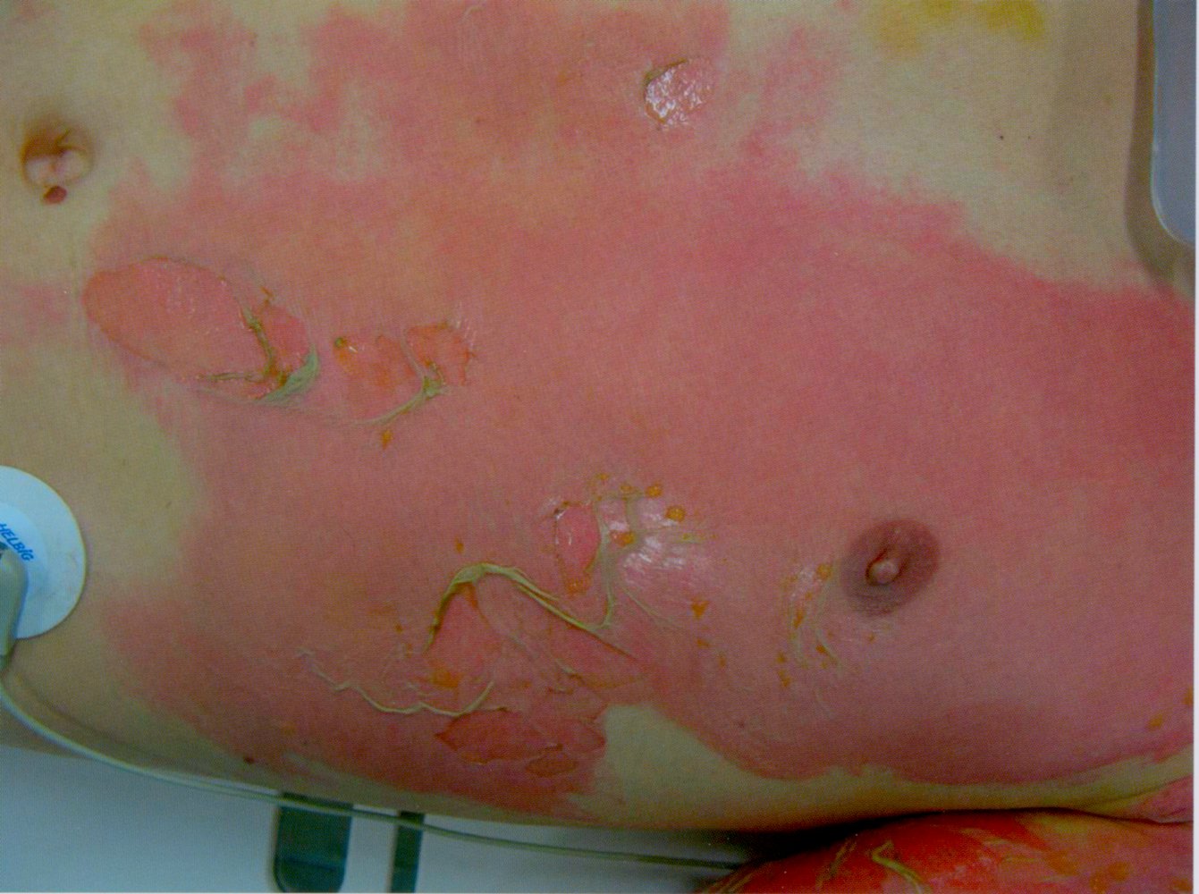 Second-degree burn (2b; deep partial-thickness burn)